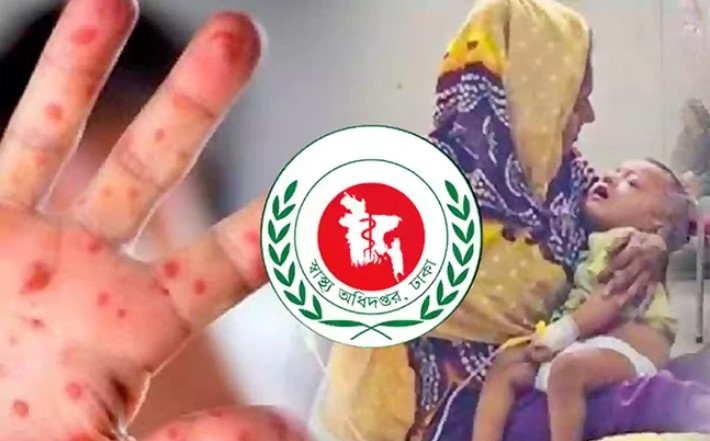 হাম ও উপসর্গে আরও ৯ শিশুর মৃত্যু, একদিনে শনাক্ত ৮৭